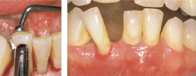 Подвижность зубов – аномалия или естественное физиологическое явление: разбираемся вместе со стоматологами