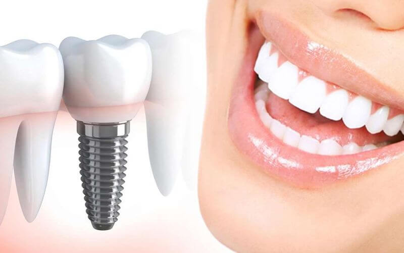 Имплантация зубов – простой и быстрый способ вернуть прежнюю улыбку и комфорт