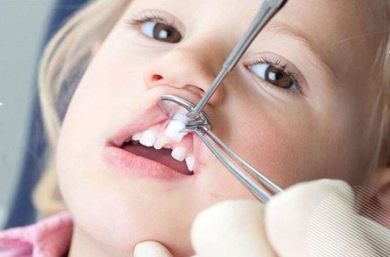 Протезування молочних зубів: особливості процедури