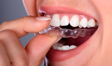 Элайнеры Flexiligner: успех лечения