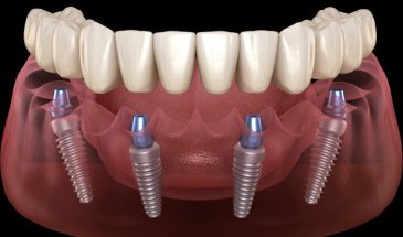 Виды имплантации зубов в Барселоне: All-on-4, скуловая, одномоментная — что выбрать?